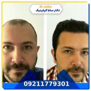 کاشت مو قبل و بعد