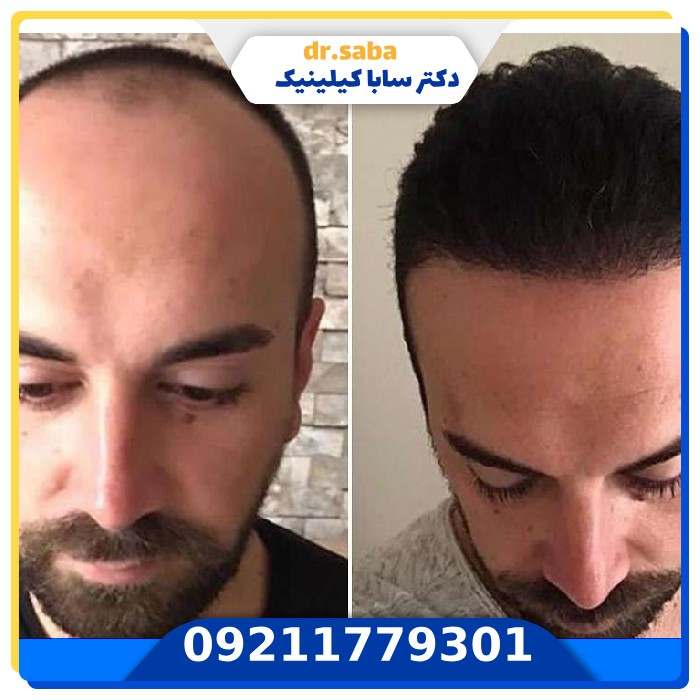 کاشت موی طبیعی+با بروز ترین تجهیزات (FIT,SUT,FUE)