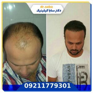 کاشت مو قبل و بعد