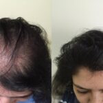 بهترین کلینیک کاشت مو زنان در تهران