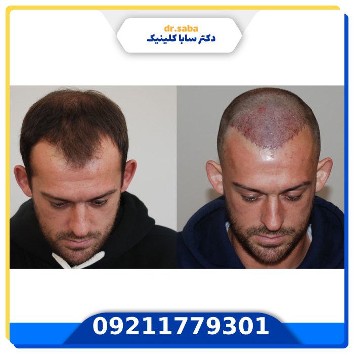 کاشت مو در تهران + تضمین 100 درصد بازگشت پول