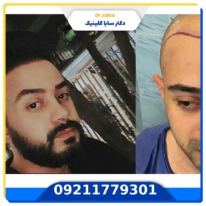 کاشت مو قبل و بعد