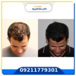 کاشت مو با سلولهای بنیادی