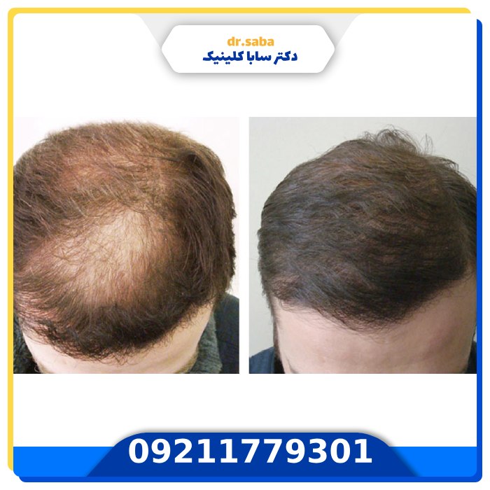 عکس ریزش مو بعد از کاشت