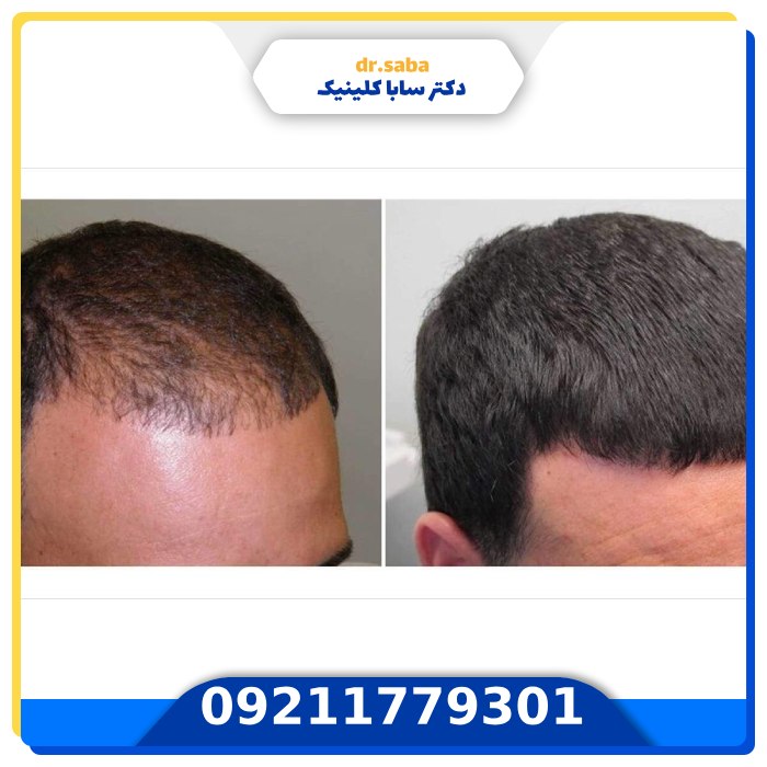 عکس ریزش مو بعد از کاشت