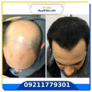 کاشت مو قبل و بعد