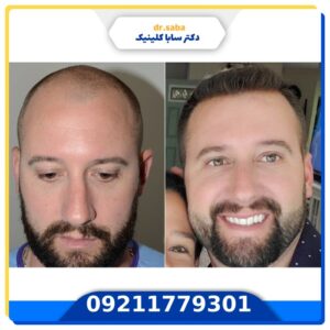 کاشت مو قبل و بعد