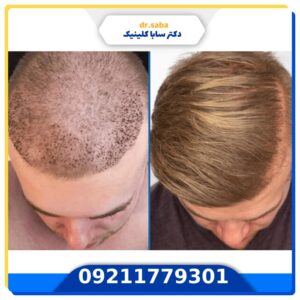 کاشت مو قبل و بعد