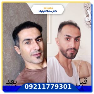 کاشت مو قبل و بعد