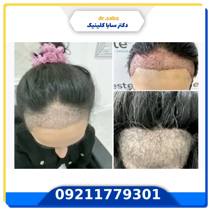 بهترین کلینیک کاشت مو زنان در تهران