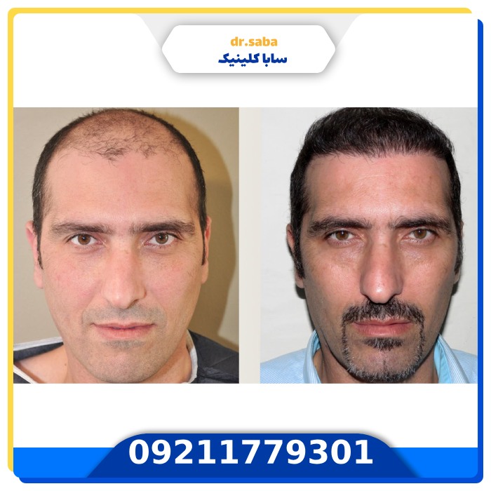 کاشت موی اقساطی