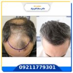 عوارض آمپول بی حسی کاشت مو