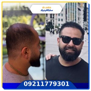 کاشت مو قبل و بعد