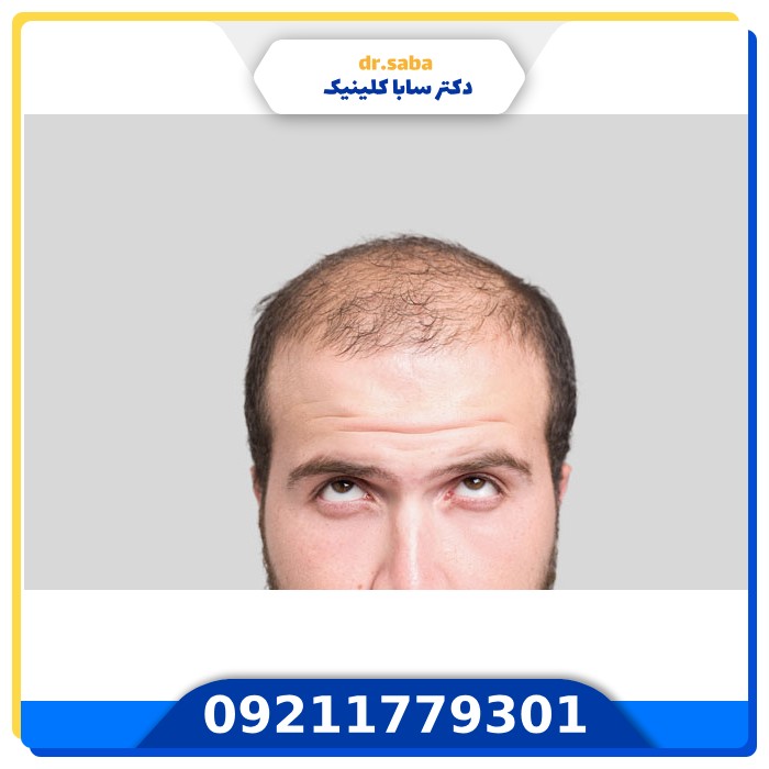 کلینیک کاشت مو در شهرک غرب+(با بهترین و جدید ترین امکانات)