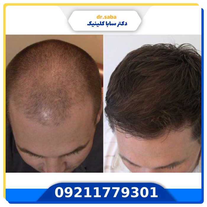 کلینیک کاشت مو در شهرک غرب+(با بهترین و جدید ترین امکانات)