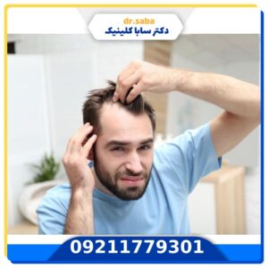 خطرناک ترین عوارض کاشت مو در مردان