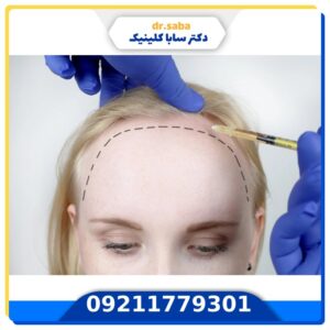 عوارض کاشت مو در زنان