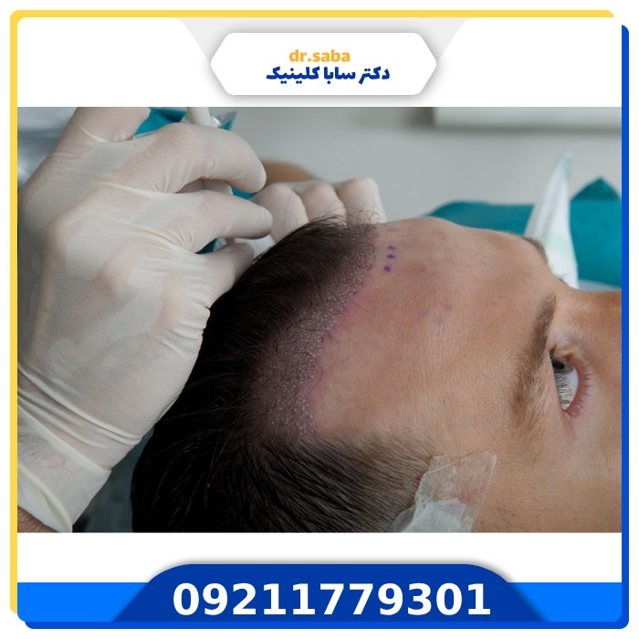 کار هایی که باید قبل از کاشت مو انجام بدهیم؟ 