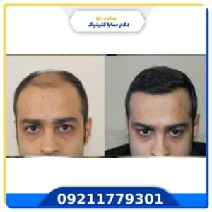 کاشت مو قبل و بعد