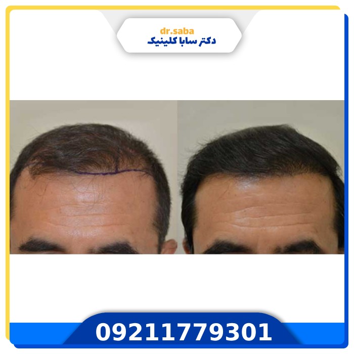 کاشت مو بدون تراشیدن سر