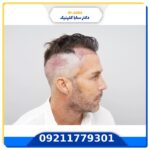 عوارض کاشت مو
