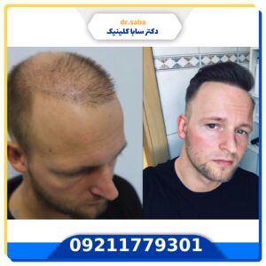 کاشت مو قبل و بعد