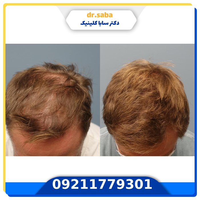 کاشت موی طبیعی+با بروز ترین تجهیزات (FIT,SUT,FUE) 