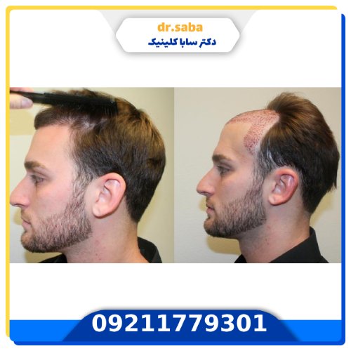 کلینیک کاشت مو در شهرک غرب+(با بهترین و جدید ترین امکانات)
