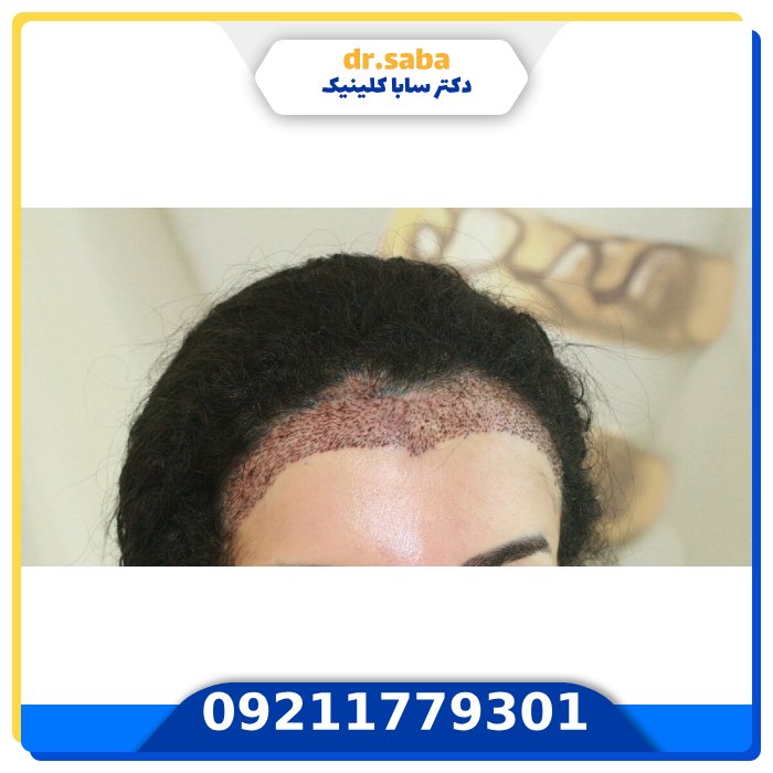 بهترین کلینیک کاشت مو زنان در تهران