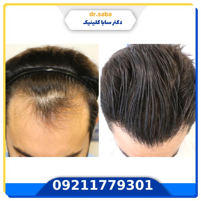 انواع روش‌های کاشت مو: از سنتی تا مدرن، کدام روش برای شما مناسب‌تر است؟