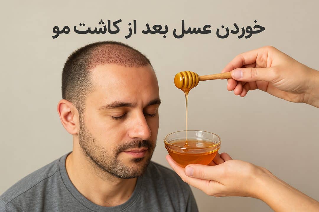 خوردن عسل بعد کاشت مو