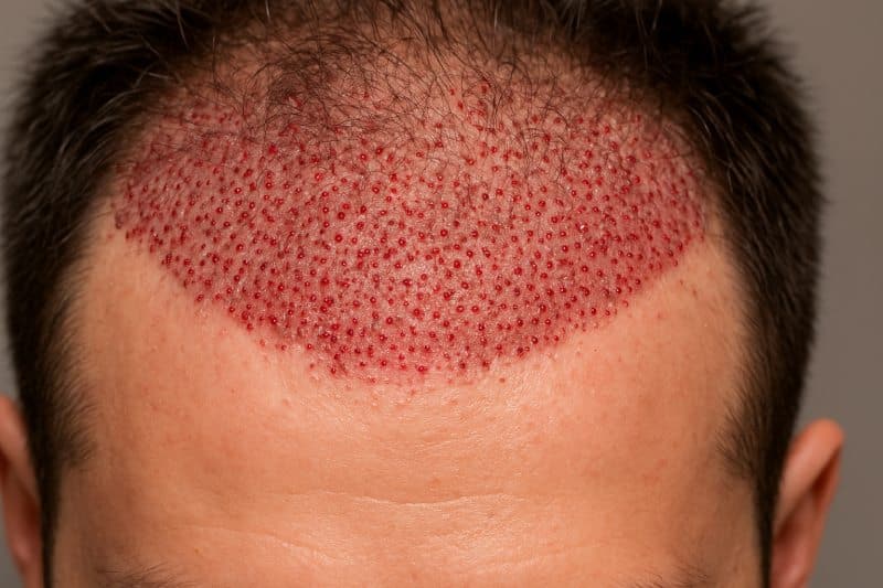 جوش بعد از کاشت مو