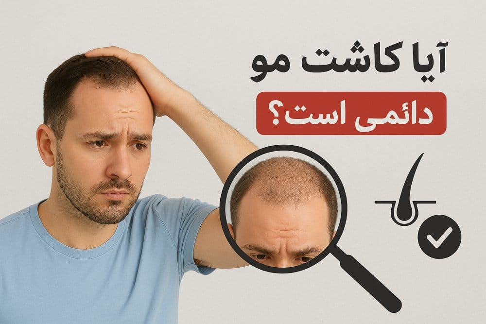 ایا کاشت مو دائمی است