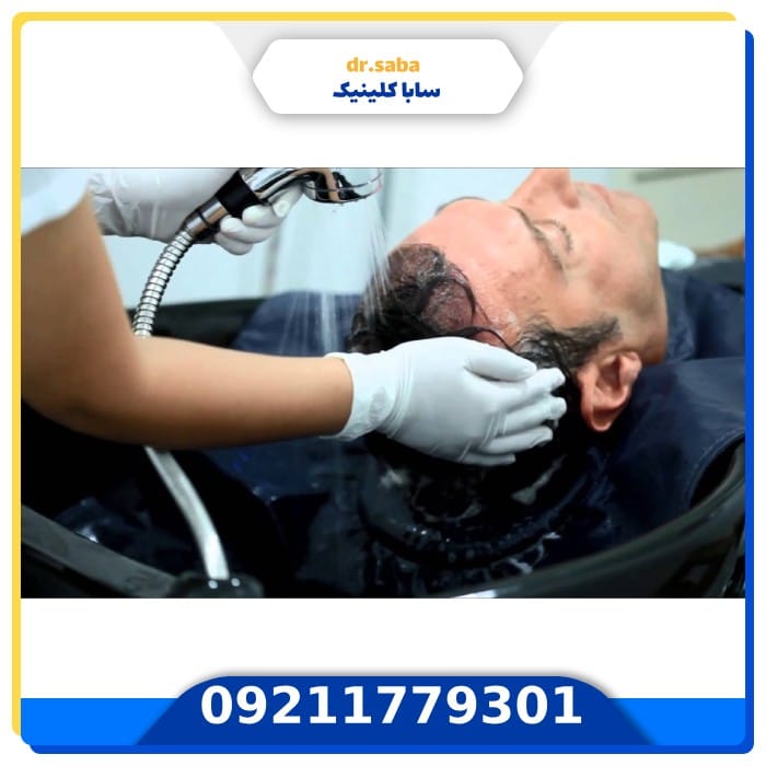 شستشو بعد از کاشت مو