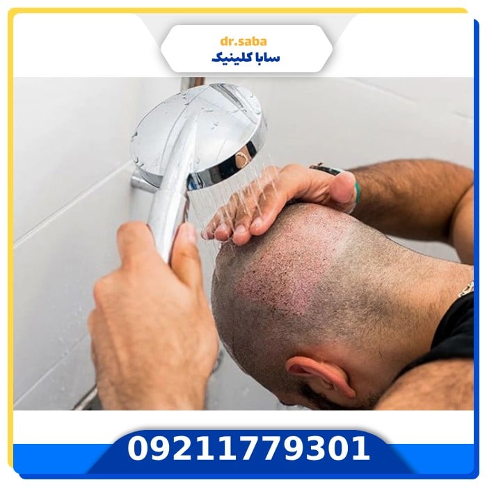 شستشو بعد از کاشت مو