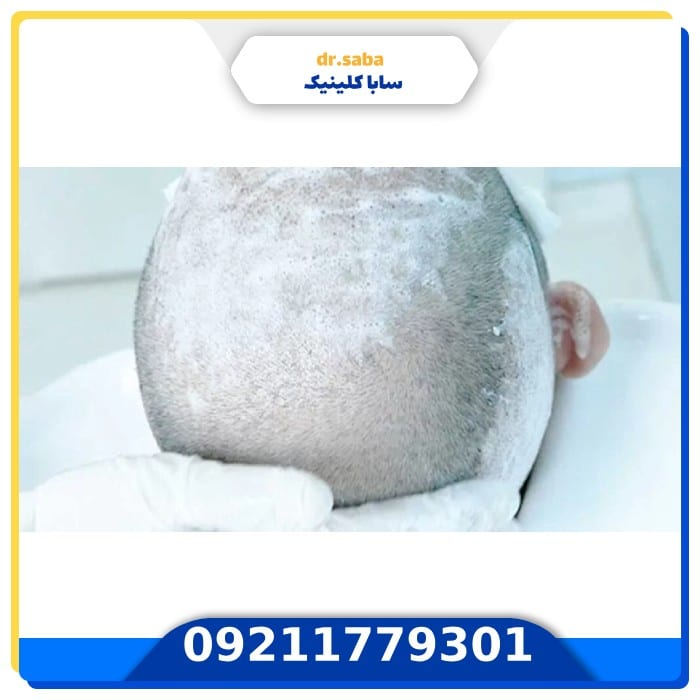 شستشو بعد از کاشت مو