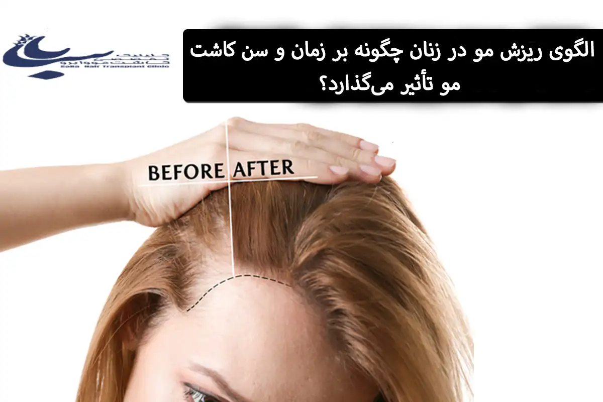 سن کاشت مو در زنان