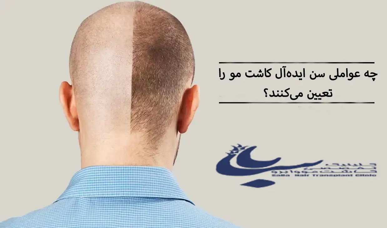 سن مناسب برای عمل کاشت مو
