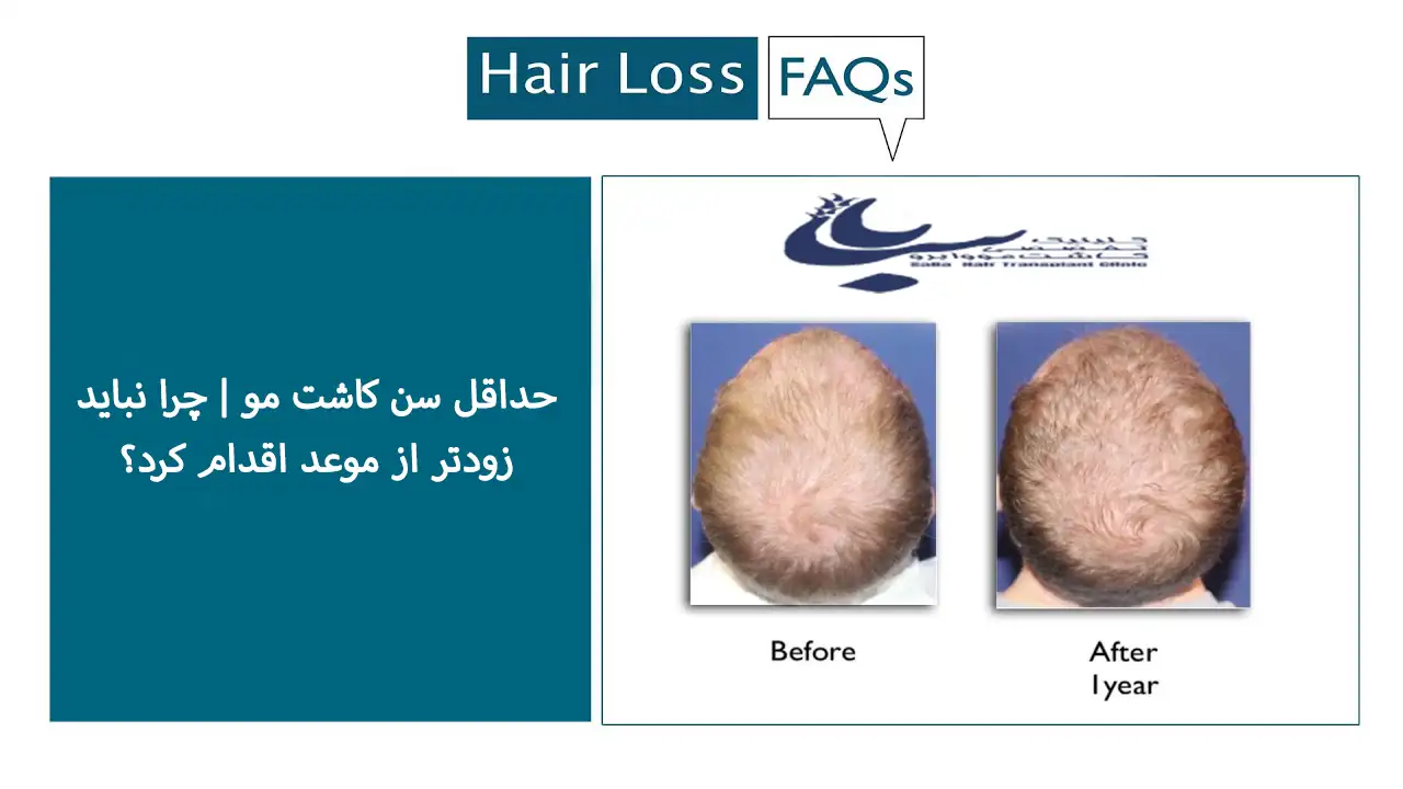 حداقل سن برای کاشت مو