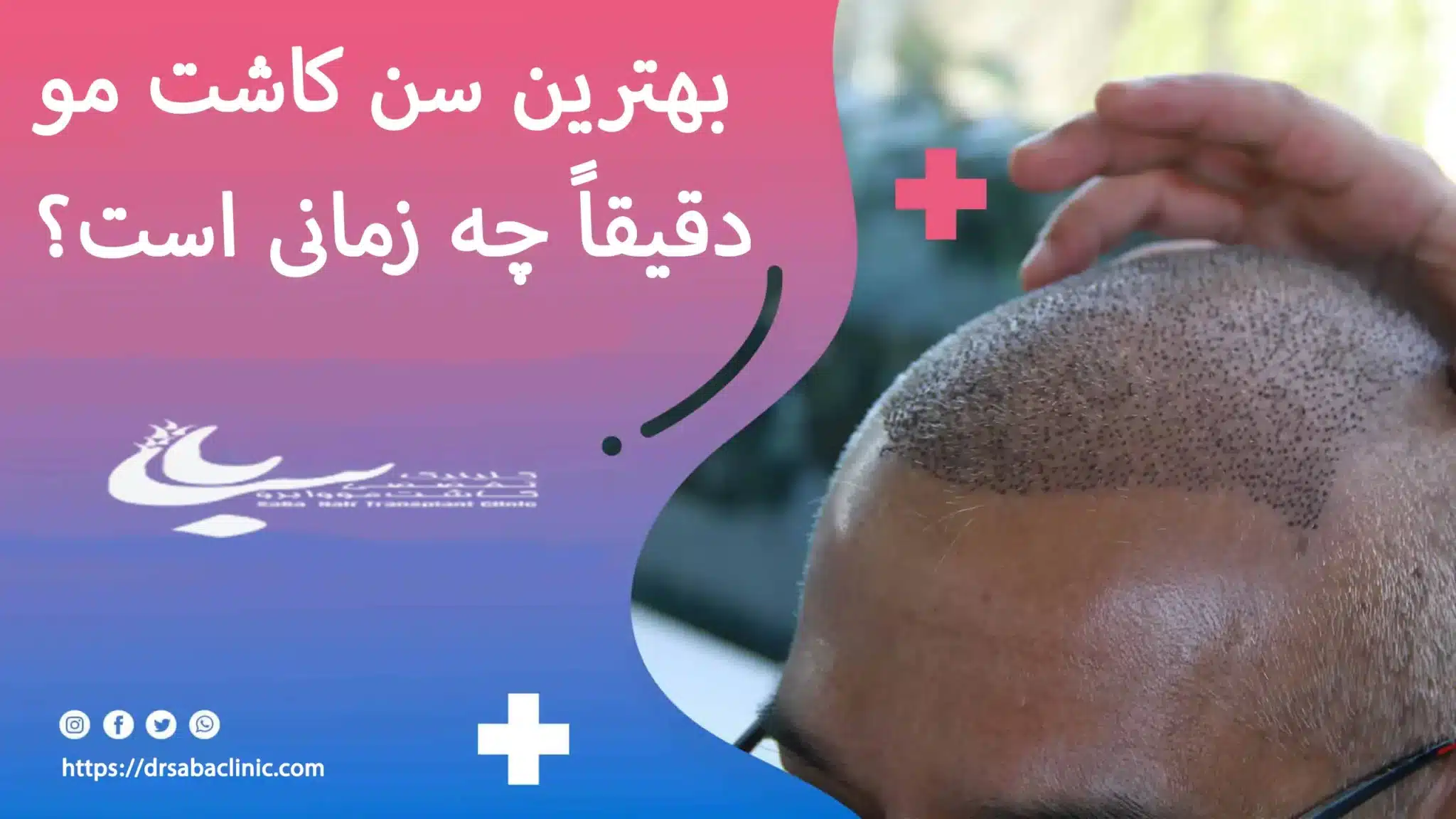 بهترین سن کاشت مو – تصویر گرافیکی از بازه سنی ایدهآل