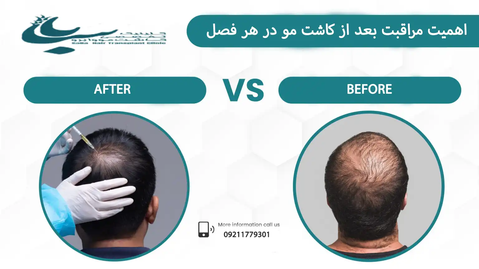 بهترین زمان برای کاشت مو در قصول مختلف و مراقبت های کلیدی