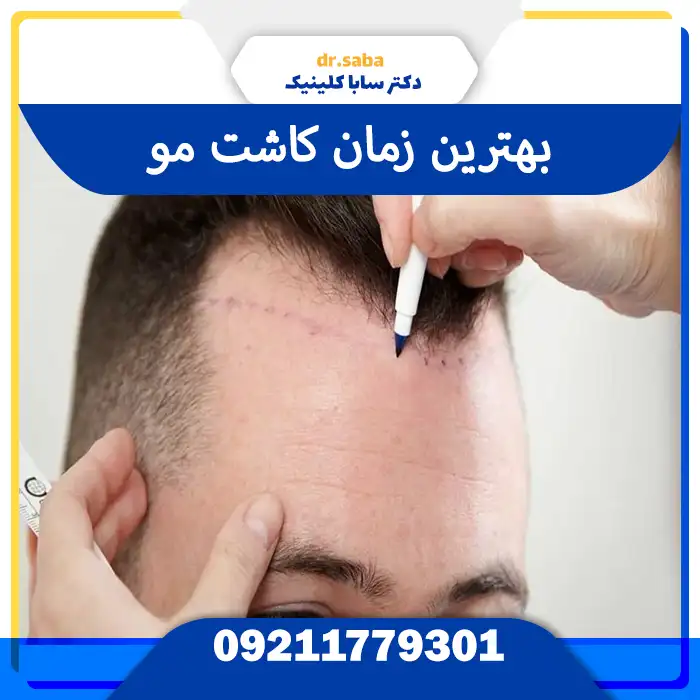 بهترین زمان کاشت مو بر اساس سن، فصل، سلامت پوست و شرایط بدنی | مقایسه علمی و تصویری برای انتخاب زمان ایده‌آل کاشت مو