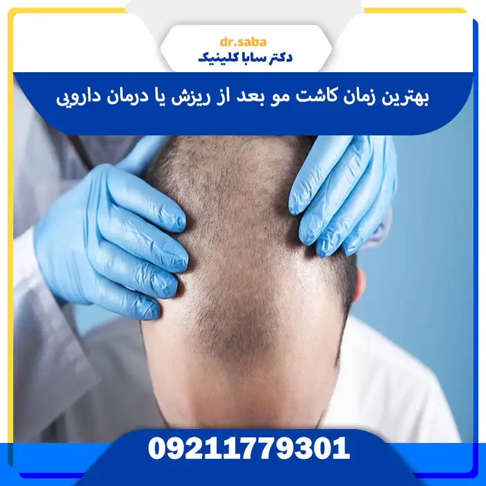 بهترین زمان کاشت مو بعد از ریزش یا درمان دارویی
