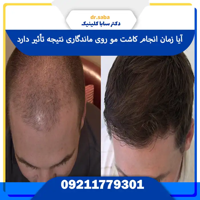 آیا زمان انجام کاشت مو روی ماندگاری نتیجه تأثیر دارد