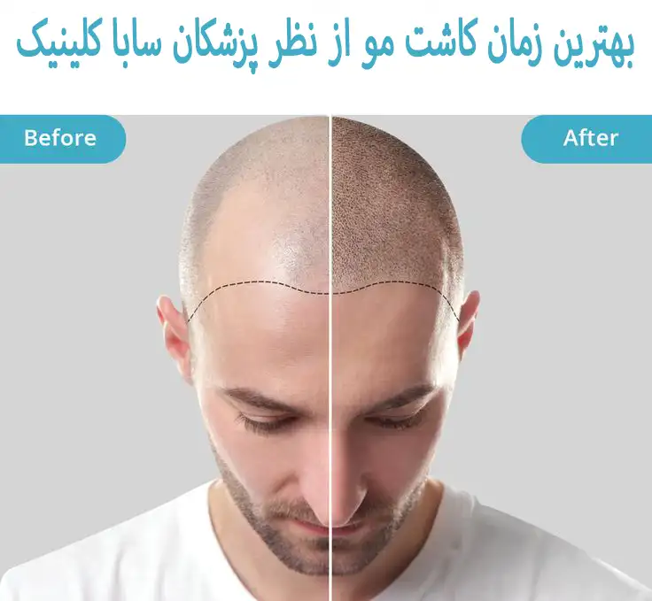 بهترین زمان برای کاشت مو