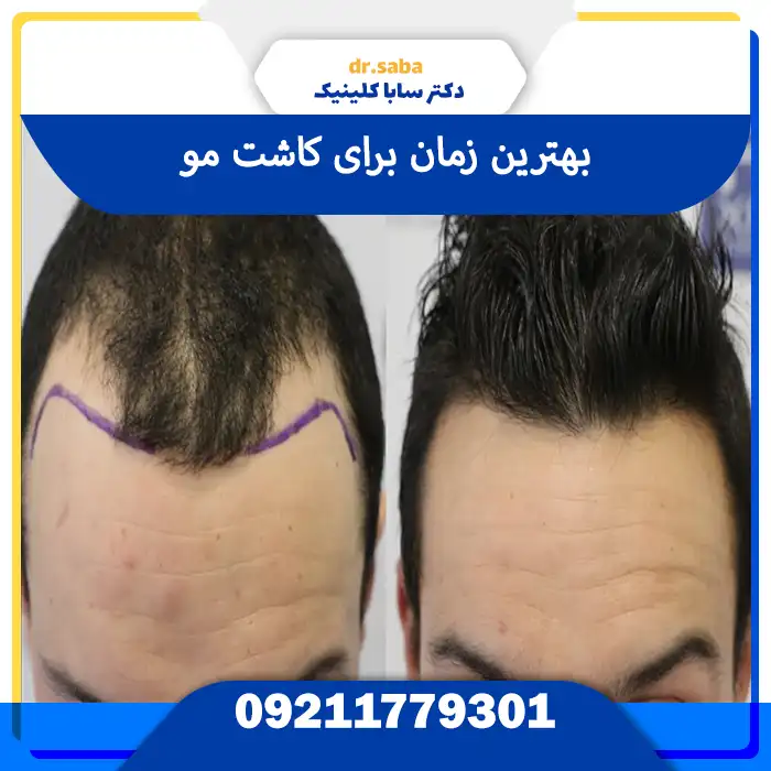 تصویر انتخاب زمان درست برای کاشت مو سر