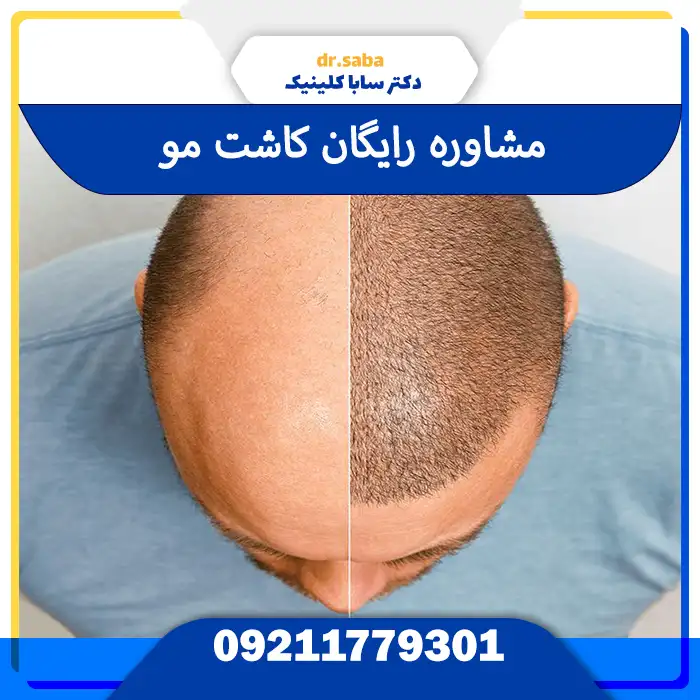 مشاوره کاشت مو رایگان و بدون هزینه
