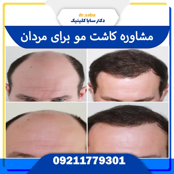 مشاوره کاشت مو برای مردان