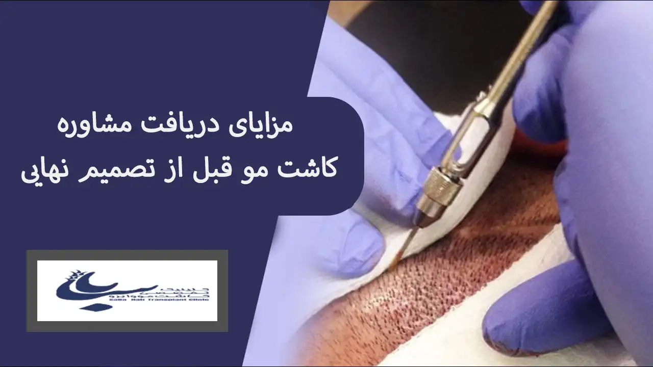 مزایا مشاوره کاشت مو 