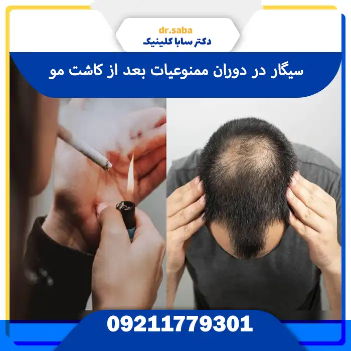 سیگار از ممنوعیات های بعد از کاشت مو